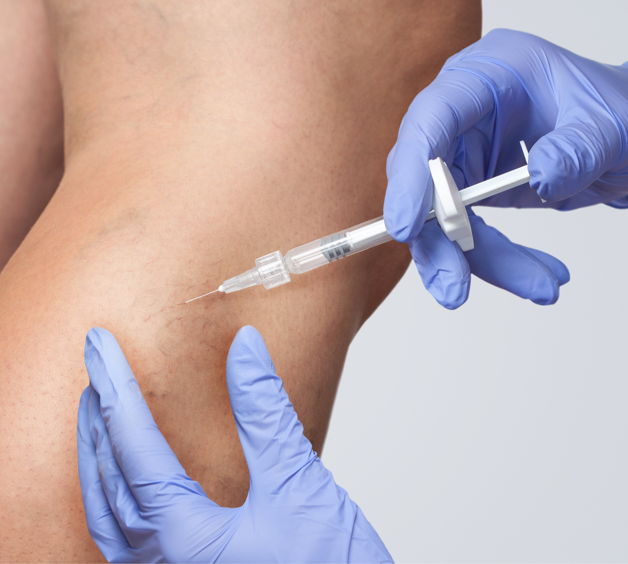 Scleroterapia per l’eczema varicoso